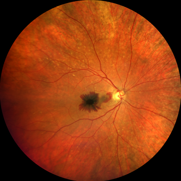 Haemorrhage can occur in macular degeneration, causing significant vision loss.