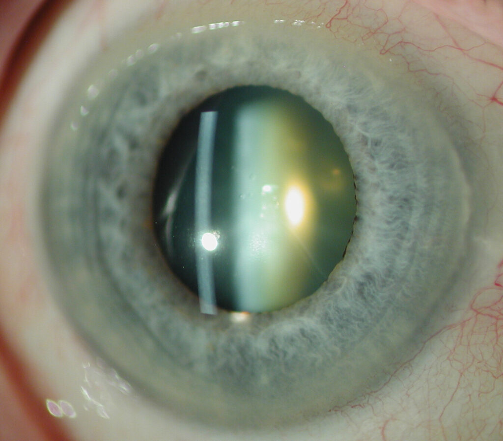 Cataract occurs when part of the crystalline lens becomes opaque or cloudy as we get older 