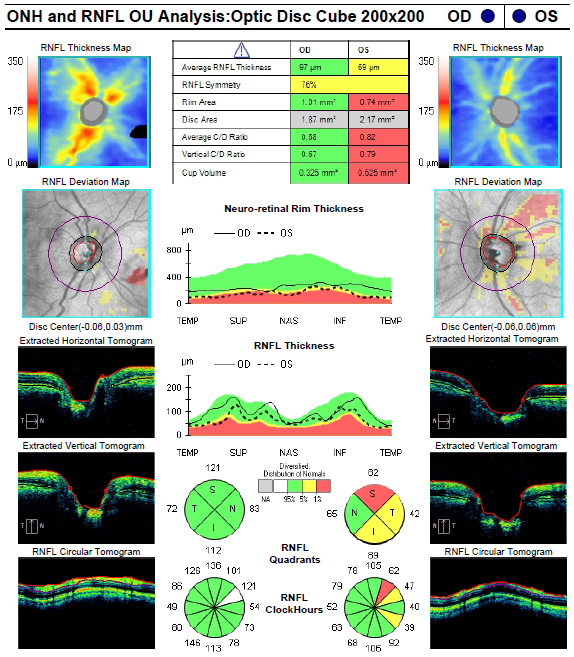 How information in the OCT scan is used to diagnose and monitor glaucoma  progression 